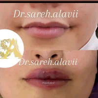 جشنواره تخفیف تزریق فیلر لب به مدت محدود توسط پزشک|خدمات آرایشگری و زیبایی|قم, دورشهر|دیوار