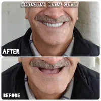 دندان مصنوعی/ ضمانتی / ایتالیایی/ جوان پسند