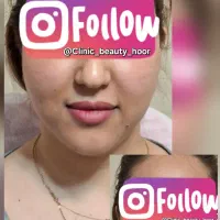 کلینیک زیبایی گلد( فیلر ژل بوتاکس) توسط پزشک|خدمات آرایشگری و زیبایی|سنندج, |دیوار