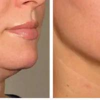 با کمتر از دو ملیون غبغبت رو از بین ببر بدون درد