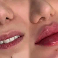 تزریق ژل وفیلرو انزیم و ساکشن فیلربادی