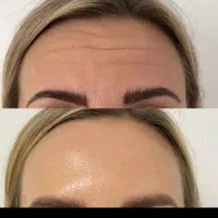 بوتاکس ،ژل و فیلر لب ،فول فیس فقط تا فردا