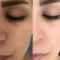 کرم بیوممتیک ضدلک وکک‌ مک باتخفیف ویژه فقط تاامشب