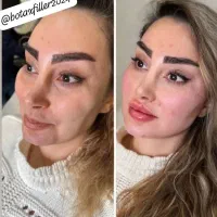 آموزش و خدمات تخصصی فیلر وبوتاکس