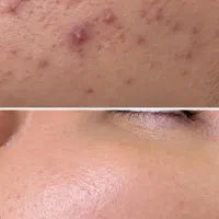 ژل و تونر و صابون برای لک و جوش