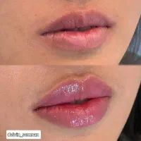 تخفیف ویژه کلینیک زیبایی دلوین،لیزر مو ،تست رایگان