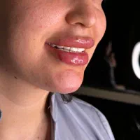 تزریق بوتاکس فیلرژل مزوژل مزوتراپی prp پروتوکین