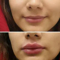 خدمات واموزش تخصصی ژل بوتاکس تتو چالگونه پرسینگ