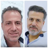 ۱۲ تومن تخفیف کاشت مو و ابرو