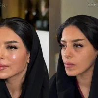 فیلرلب مادلینگ جوانسازی بوتاکس فیلرزیرچشم فیلربادی|خدمات آرایشگری و زیبایی|تهران, سید خندان (جلفا)|دیوار