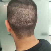 میکرو اسکالپ  چهل درصد تخفیف ویژه