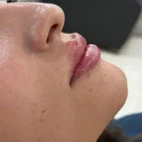 جشنواره ژل توسط پزشک برای شما عزیزان|خدمات زیبایی و سلامت|کرمانشاه, |دیوار