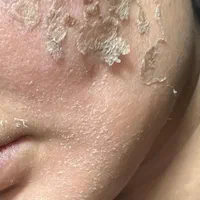 پاکسازی پوست درمان جوش جای جوش لک و کک ومک|خدمات آرایشگری و زیبایی|اصفهان, ملک‌شهر|دیوار