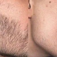 مرد بدون ریش صددرصد کنسله
