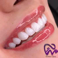 کامپوزیت دندان لبه شیشه ای اقساط بدون سود ،|خدمات آرایشگری و زیبایی|تهران, قیطریه|دیوار