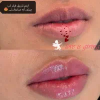 فیلرزیر چشم، زاویهفک، لیفت شقیقه، بوتاکس، لب نچرال|خدمات آرایشگری و زیبایی|مشهد, سرافرازان|دیوار