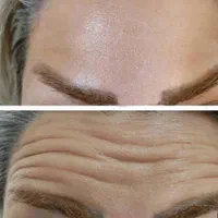 تزریق بوتاکس و ژل در کلینیک(توسط پزشک،)|خدمات آرایشگری و زیبایی|مشهد, هفت تیر (آب و برق)|دیوار