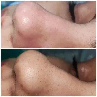 پاکسازی پوست،درمان منافذ باز،آکنه،تخلیه سر سیاه|خدمات آرایشگری و زیبایی|اهواز, سپیدار|دیوار