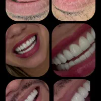 ایمپلنت ۲۴ ماهه بدون پیش پرداخت