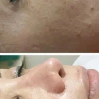 آموزش فیشیال تخصصی. مزو جوانساز صورت|خدمات آموزشی|کوهدشت, |دیوار