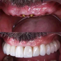 دندانپزشکی،ایمپلنت و اوردنچر با وام ۶۰ ماهه