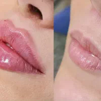 جشنواره بوتاکس فقط 850 و فیلر1200