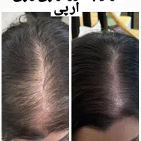 ۶۵درصد تخفیف در کلینیک(متن را کامل بخوانید )|خدمات آرایشگری و زیبایی|محمدشهر, محمدشهر|دیوار