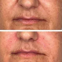 کامپوزیت دندان لیزرمو ژل بوتاکس فیلر مزو پی ارپی|خدمات آرایشگری و زیبایی|اسلامشهر, زرافشان|دیوار