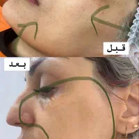 فیشیال و پاکسازی عمیق پوست|خدمات آرایشگری و زیبایی|مشهد, شهرک امام هادی (شهرک غرب)|دیوار