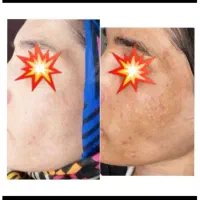 کرم تخصصی ضدلک و روشن کننده(درخشان)ارسال رایگان