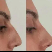 ژل و بوتاکس تصمینی