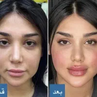 ژل لب|خدمات آرایشگری و زیبایی|شهرضا, |دیوار