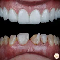 دندانپزشکی و زیبایی بدون پیش پرداخت|خدمات آرایشگری و زیبایی|قم, نوقطار|دیوار