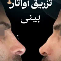 در10دقیقه بدون جراحی به بینی مورد علاقت برس