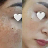 ضدلک قوی بیوممتیک