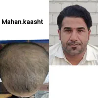 کاشت مو و ابرو اقساطی حتی با سفته|خدمات آرایشگری و زیبایی|مشهد, وکیل‌آباد|دیوار
