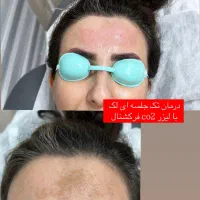 لیزر موهای زائد الکس پلاس (شاتی) بدون ژل/درمان لک|خدمات آرایشگری و زیبایی|رشت, گلسار|دیوار