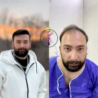 کاشت مو تضمین رشد و شرایط اقساطی
