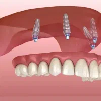 خدمات ایمپلنت دیجیتال|خدمات آرایشگری و زیبایی|شیراز, معالی‌آباد|دیوار