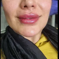 تزریق ژل وبوتاکس و آموزش فیلر با 5سال سابقه کاری