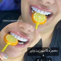 کامپوزیت دندان،روکش،لمینت،اموزش کامپوزیت|خدمات آرایشگری و زیبایی|فردیس, فردیس|دیوار