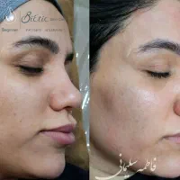مزونیدلینگ پوست باموادخاویاروکوکتل موی سروابرو