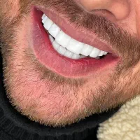 انجام درمان دندان و ایمپلنت با بیمه های تکمیلی