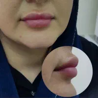 تخفیف تکرار نشدنی فیلر صورت و بوتاکس