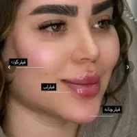 ژل،بوتاکس،فیلربادی باسن بیکینی،پی ارپی زاویه سازی
