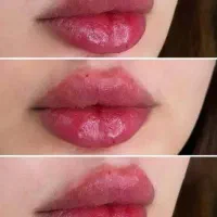 تزریق ژل و بوتاکس .کانتوریگ صورت .زاویه سازی