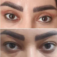 بلفاروپلاستی ،لیفت صورت و شقیقه،ساکشن غبغب