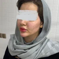 جشنواره لابیاپلاستی تزریق چربی تزریق فیلربادی غبغب|خدمات آرایشگری و زیبایی|تهران, عبدل‌آباد|دیوار
