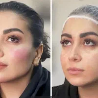 تخفیف ویژه ژل،بوتاکس،هایفو،بلفارو،انواع لیفت صورت