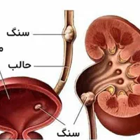 درمان گیاهی کلیه سنگ ساز